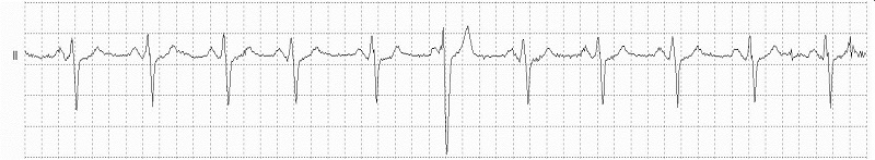 Fusion of ventricular and normal beats Rhythm Strip